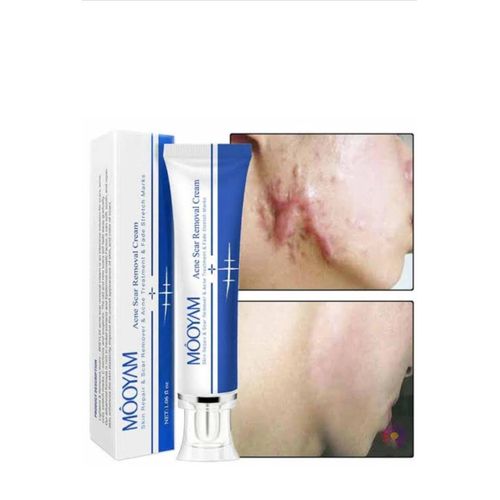 MOOYAM Acne and Scar Removal Cream