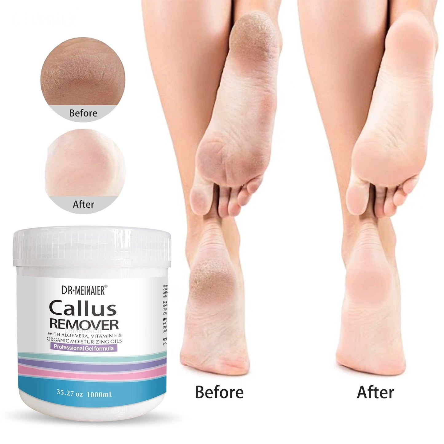 Dr. Meinaier Callus Remover