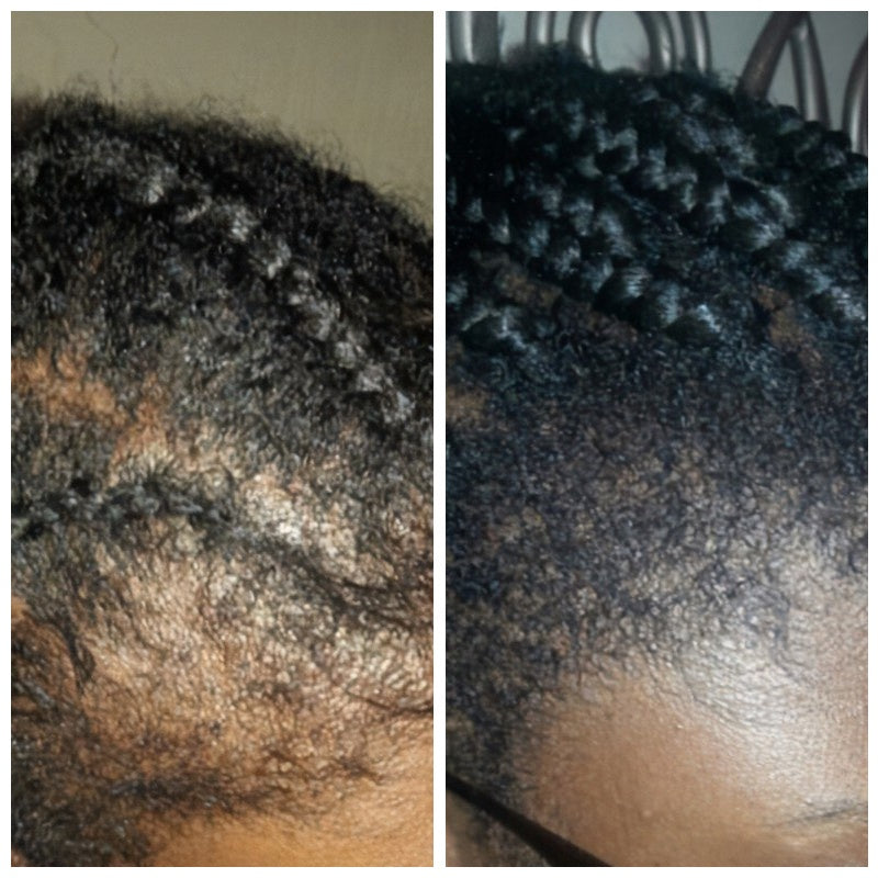 KORMESIC Hair Growth Serum – 50g