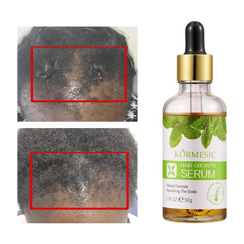 KORMESIC Hair Growth Serum – 50g