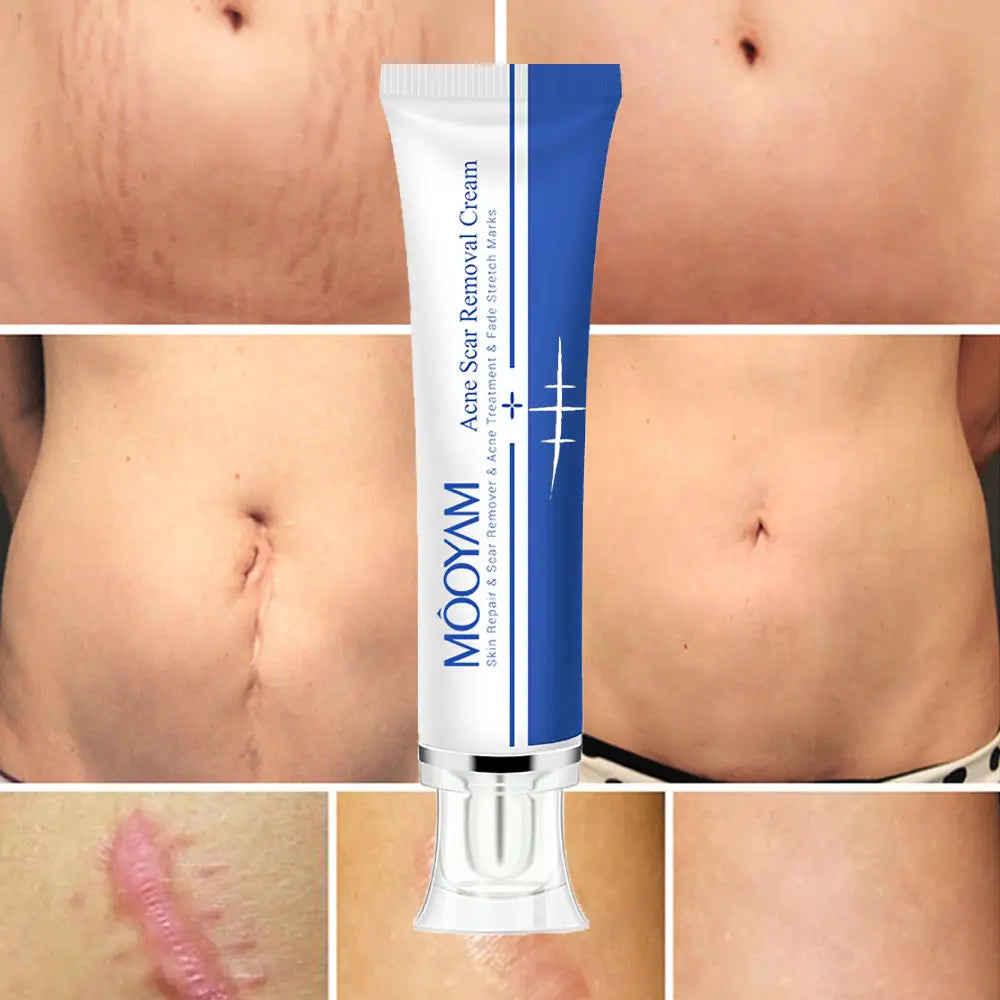 MOOYAM Strong Effective Acne Scar Removal Cream