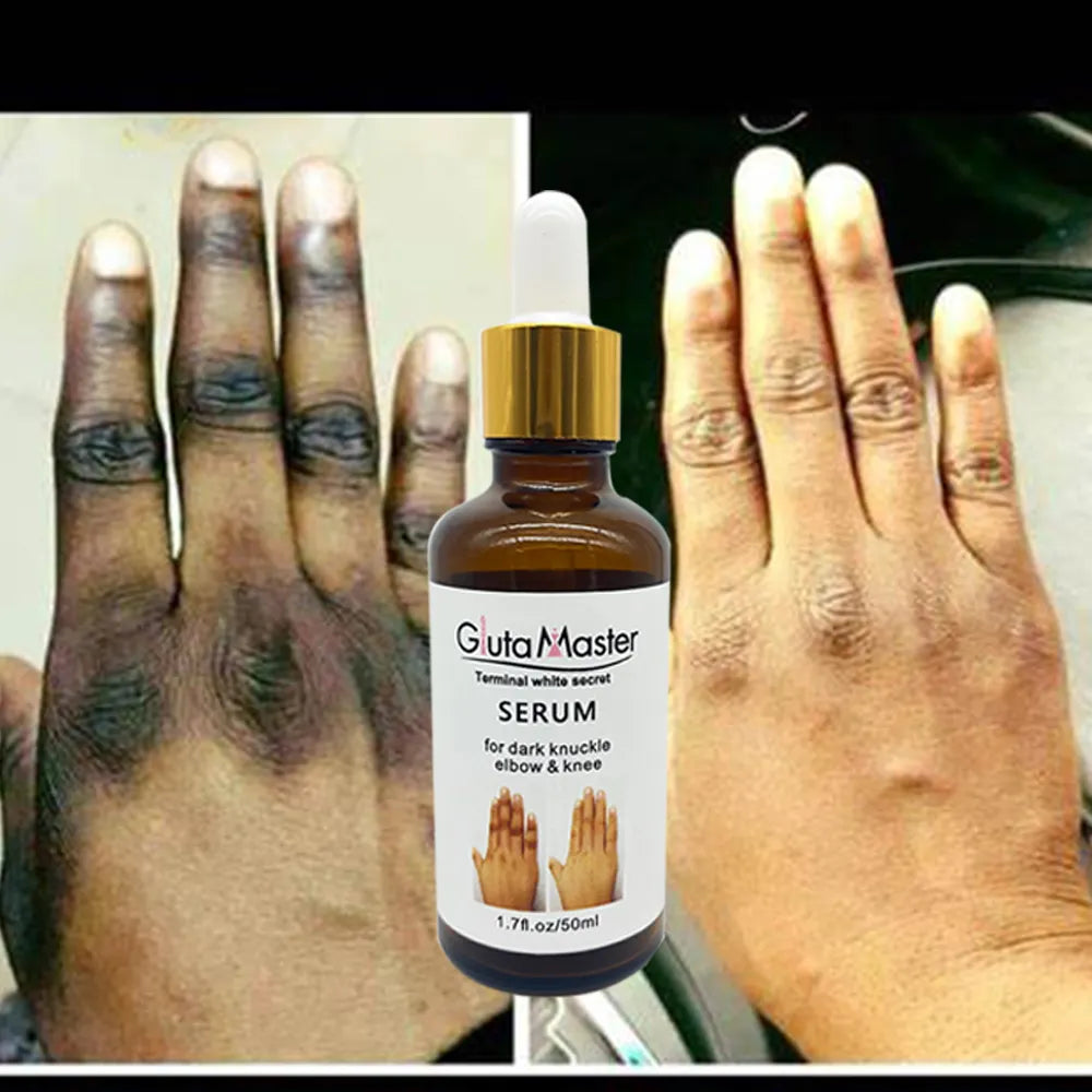 Gluta Master Serum for Dark Knuckles, Knees, and Elbows