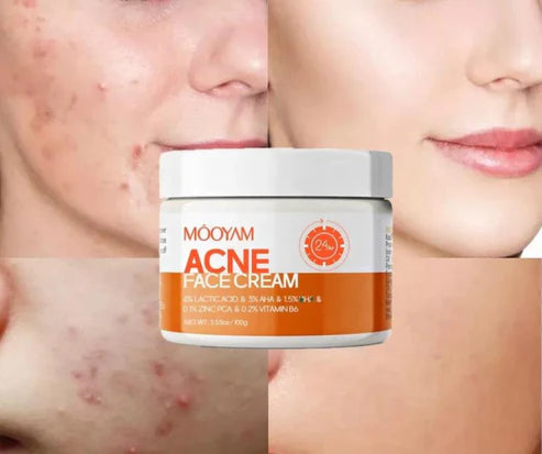 MOOYAM Acne Face Cream (30g)