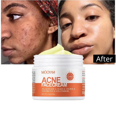 MOOYAM Acne Face Cream (30g)