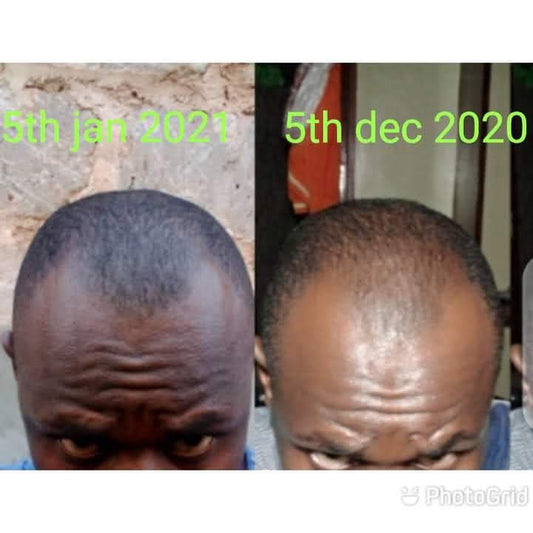 KING OF GINGER 7 days ginger hair growth stimulator, anti-breakage and hair loss treatment oil organic germinal serum 3