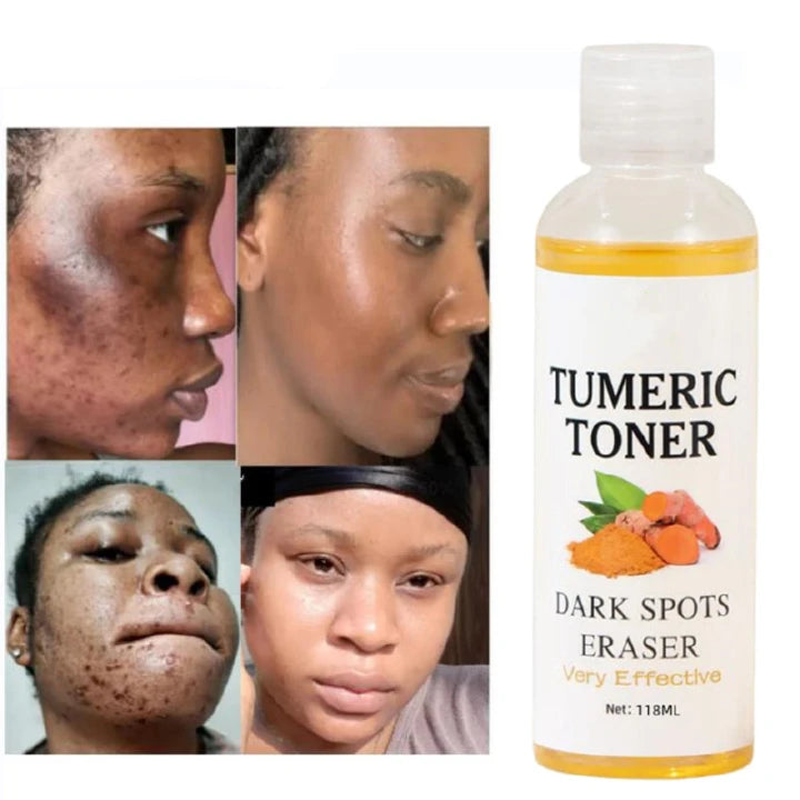 MOOYAM Quick Dark Spots Corrector Serum Tumeric Toner Acne Remover Fade Dark Spots Eraser Skin Care Serum- MOOYAM -