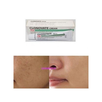 Clonovate Skin Lightening Cream-15g Very Effective