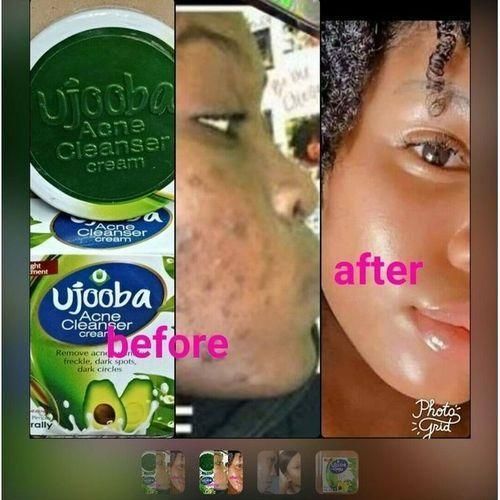Ujooba Acne Cleanser Cream