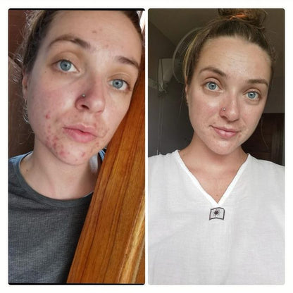 The Ordinary Salicylic Acid 2% Anhydrous Solution