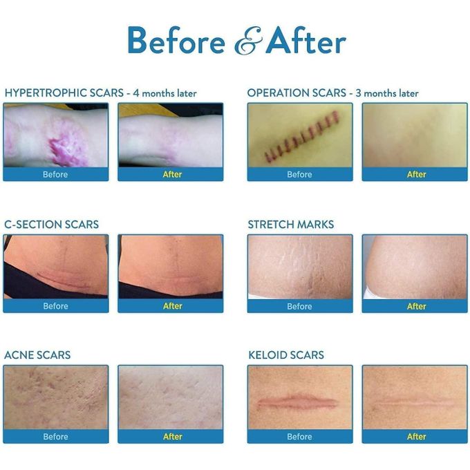 Aroamas Scar Removal Sheets – Professional Silicone Scar Treatment (8 Sheets | 4-Month Supply)