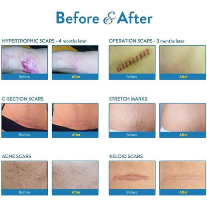 Aroamas Scar Removal Sheets – Professional Silicone Scar Treatment (8 Sheets | 4-Month Supply)
