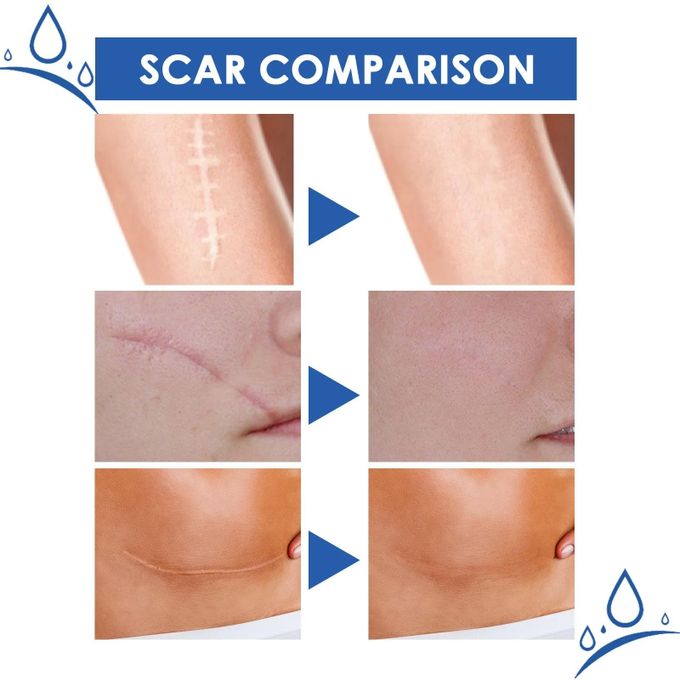 JAYSUING Scar Removal Cream