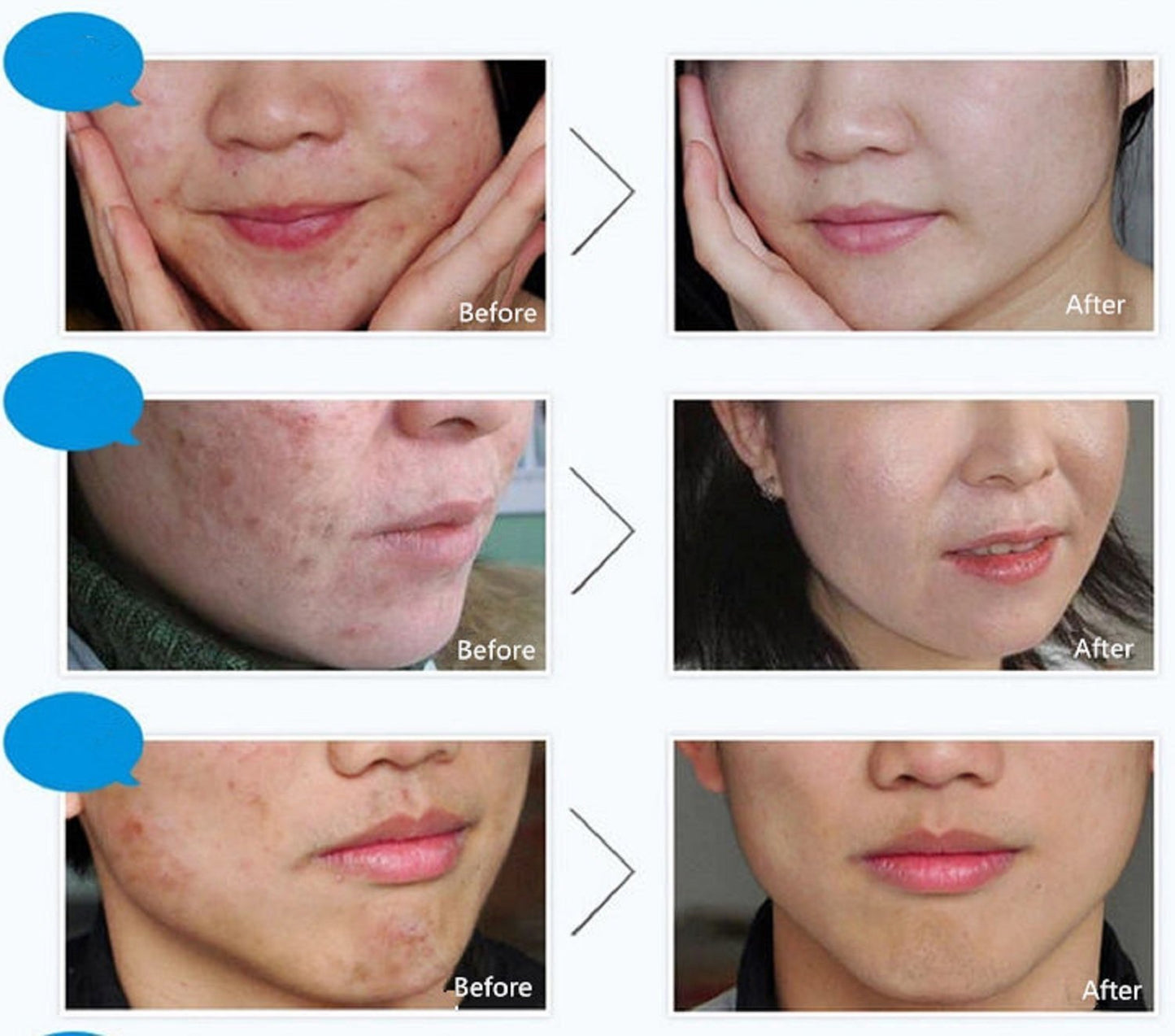 BIOAQUA Removal of Acne Rejuvenation Cream