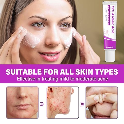 Sauvasine Azelaic Acid 12% Facial Cream with Hyaluronic Acid & Niacinamide – Fade Dark Spots, Acne & Redness