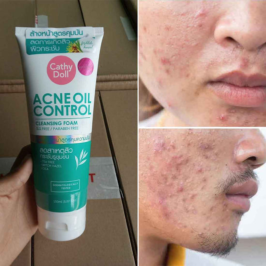 Cathy Doll Acne Oil Control Cleansing Foam (150ml)