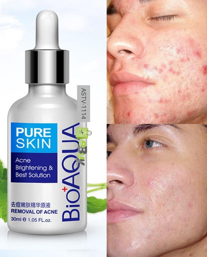 BIOAQUA Acne Removal & Acne Serum Solution
