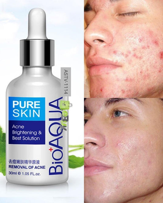 BIOAQUA Acne Removal & Acne Serum Solution