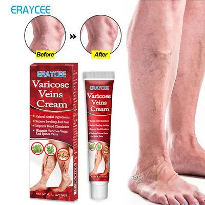 Eraycee Varicose Veins Cream