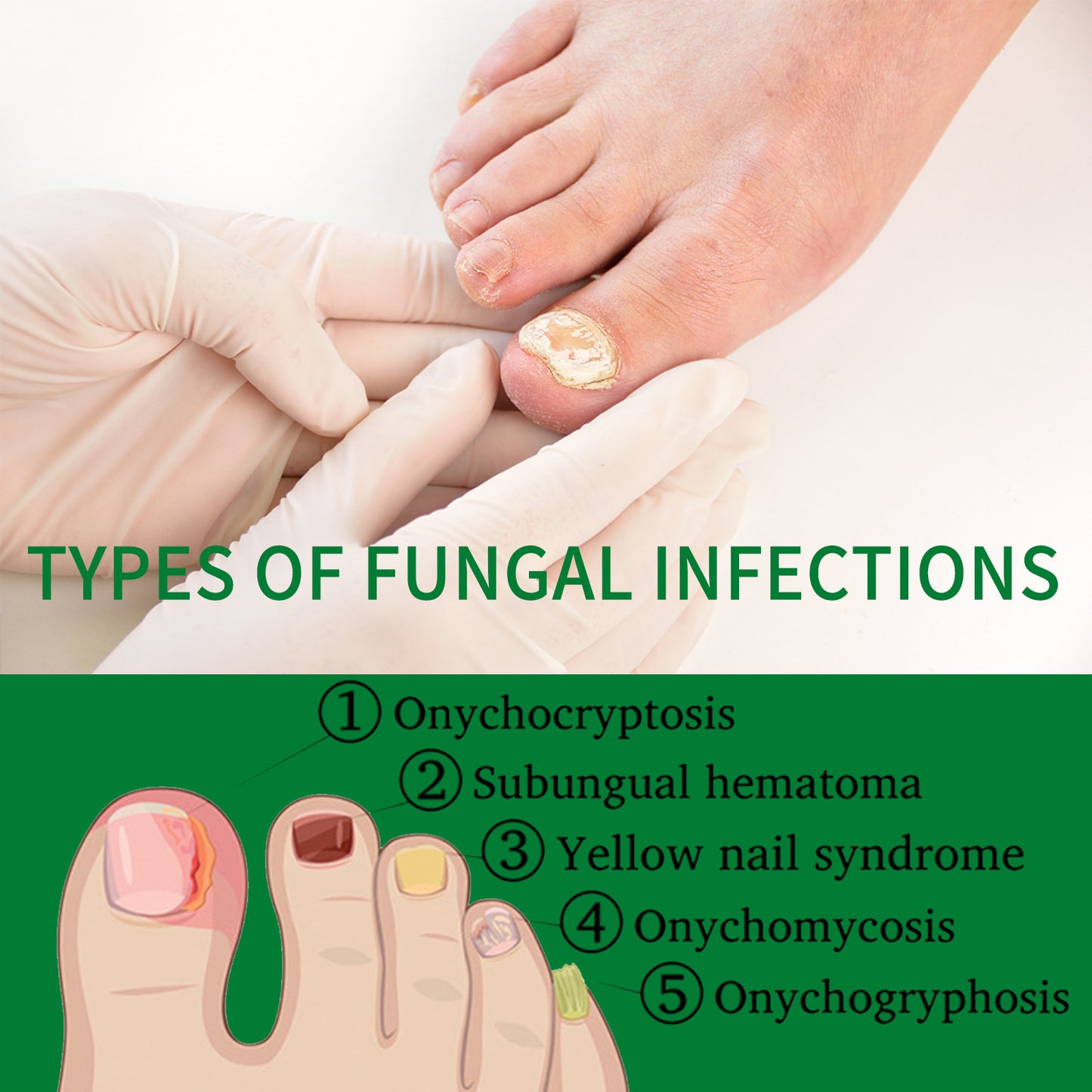 Jaysuing 7 Days Nail Fungus Treatment