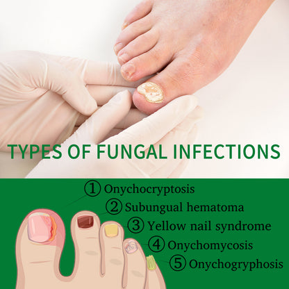 Jaysuing 7 Days Nail Fungus Treatment