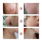 🔥 FLASH SALE — MOOYAM Acne Scar Removal Cream | Fade Dark Spots + Even Skin Tone | KSh 1,800