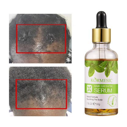 KORMESIC Hair Growth Serum – 50g