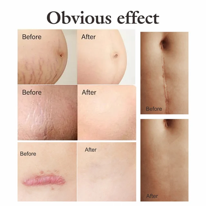 O'carly Stretch marks removal and skin firming oil