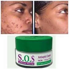 Pharmaderm SOS Zero Acne Facial Antiseptic Cream