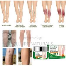 Guanjing Varicose Vein Cream Spider Varicose Vein Cream Improves Blood