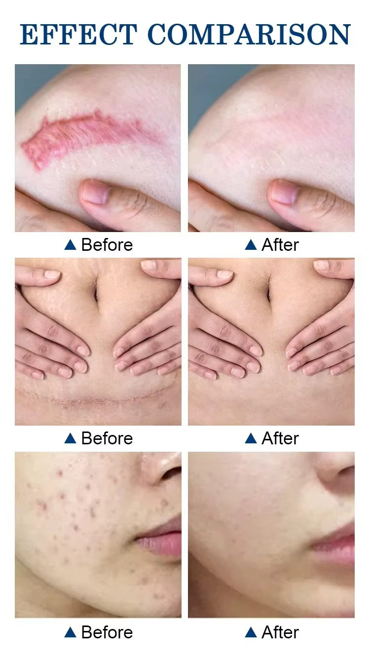 🔥 FLASH SALE — MOOYAM Acne Scar Removal Cream | Fade Dark Spots + Even Skin Tone | KSh 1,800 (