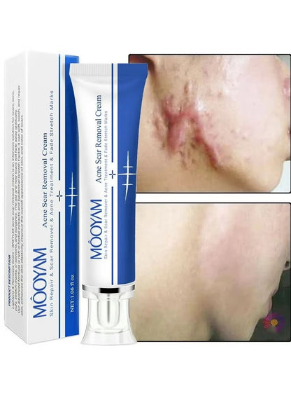 🔥 FLASH SALE — MOOYAM Acne Scar Removal Cream | Fade Dark Spots + Even Skin Tone | KSh 1,800 (