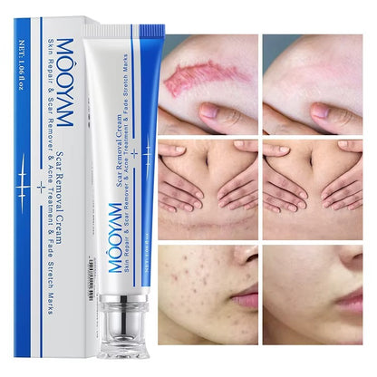 🔥 FLASH SALE — MOOYAM Acne Scar Removal Cream | Fade Dark Spots + Even Skin Tone | KSh 1,800 (