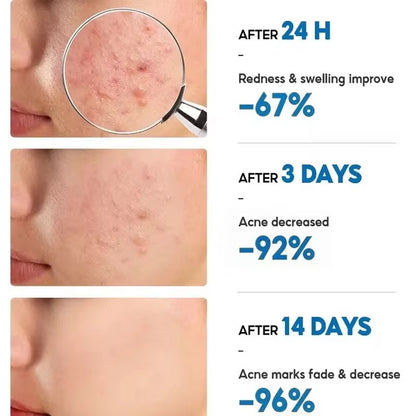 KORMESIC Acne Gel