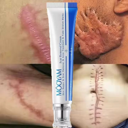 🔥 FLASH SALE — MOOYAM Acne Scar Removal Cream | Fade Dark Spots + Even Skin Tone | KSh 1,800 (