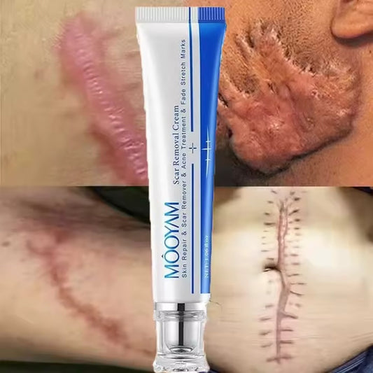 🔥 FLASH SALE — MOOYAM Acne Scar Removal Cream | Fade Dark Spots + Even Skin Tone | KSh 1,800 (