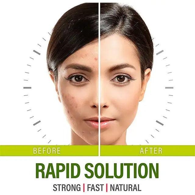 LINE ONE acne treatment pills