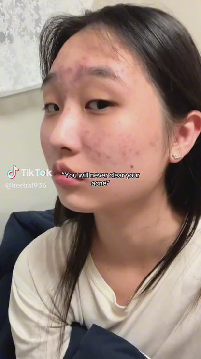 SADOER Salicylic Acid Acne Treatment Essence – 30ml