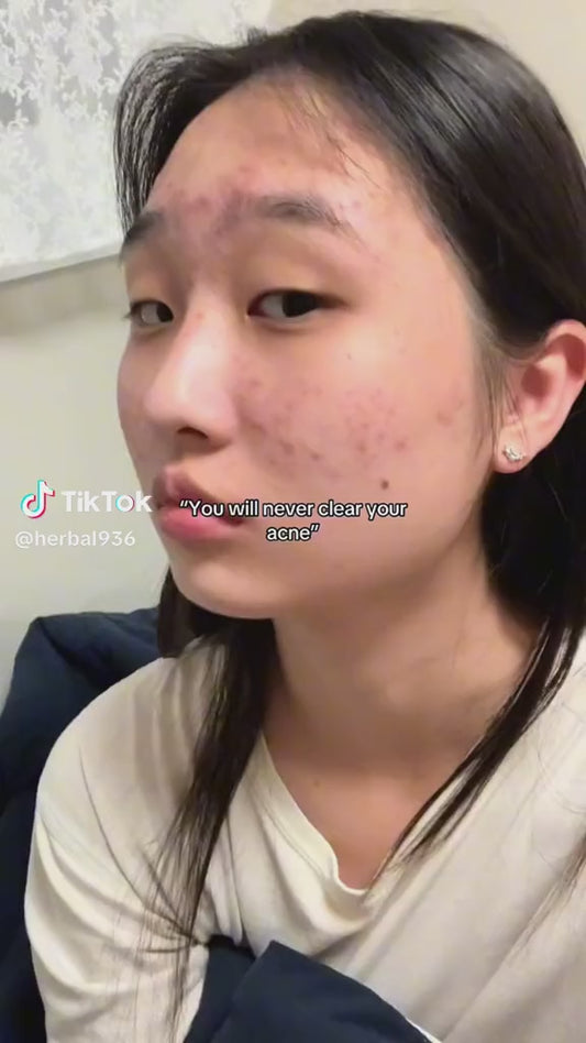 SADOER Salicylic Acid Acne Treatment Essence – 30ml