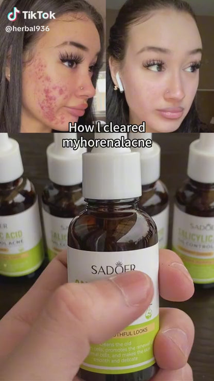 SADOER Salicylic Acid Acne Treatment Essence – 30ml