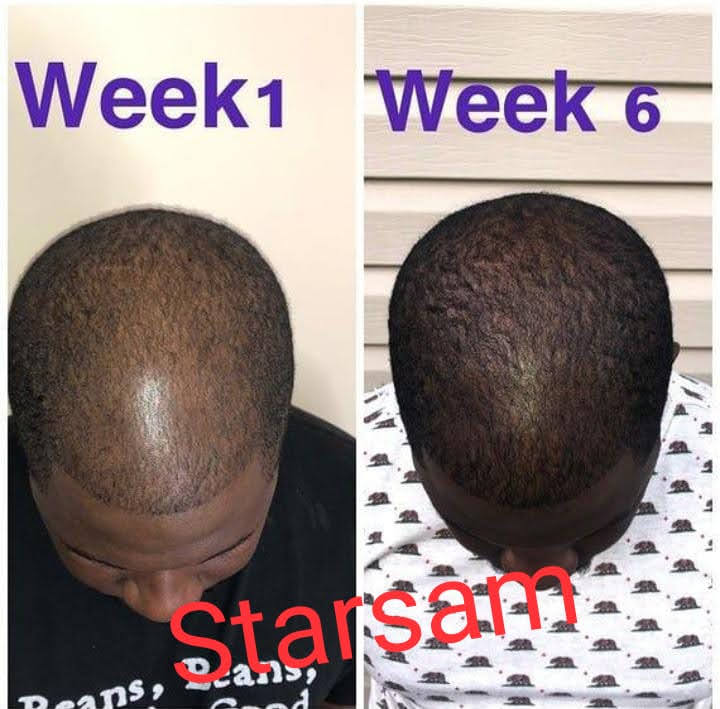 KING OF GINGER 7 days ginger hair growth stimulator, anti-breakage and hair loss treatment oil organic germinal serum 1