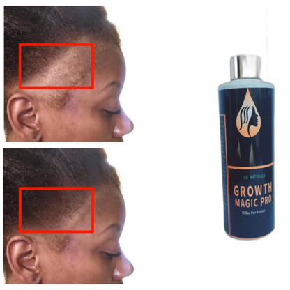 SG Naturals Growth Magic Pro 10 Days Hair Saviour 3