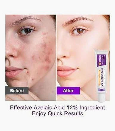 Sauvasine Azelaic Acid 12% Facial Cream with Hyaluronic Acid & Niacinamide – Fade Dark Spots, Acne & Redness C